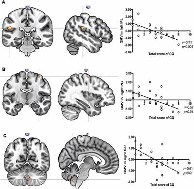 Sex-Specific Relationship of Childhood Adversity With Gray Matter Volume and Temperament